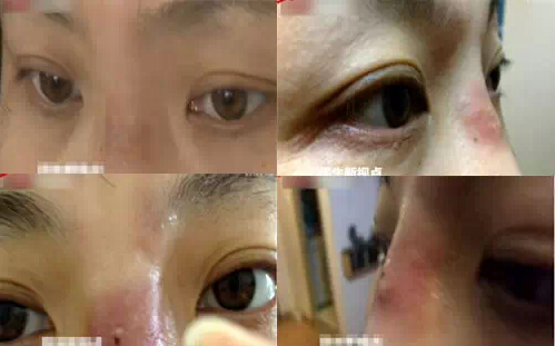 玻尿酸注射出现肉芽肿