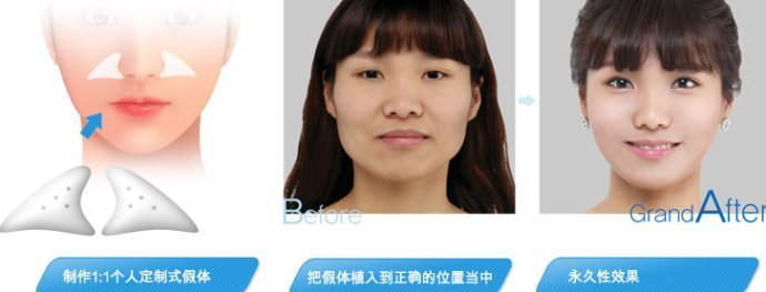 假体填充法令纹