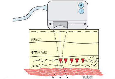 电波拉皮作用皮层