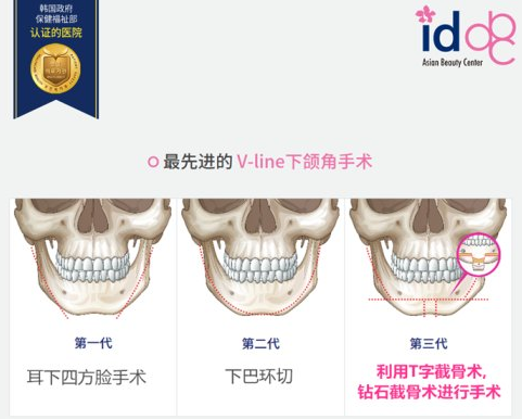 ID整形医院钻石vline下颌角整形