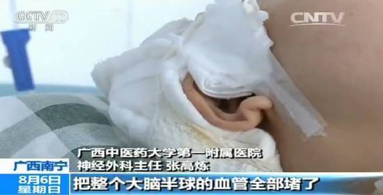 微整形变“危整形” 女子整形致偏瘫新闻医生诊疗