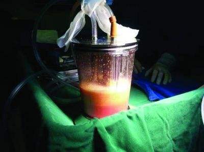 自体脂肪提取