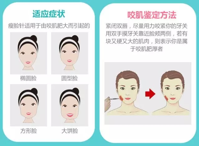 瘦脸针适应症状及咬肌鉴定方法