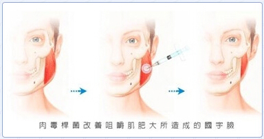 瘦脸针注射过程