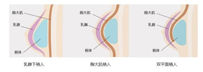 隆胸假体植入层次
