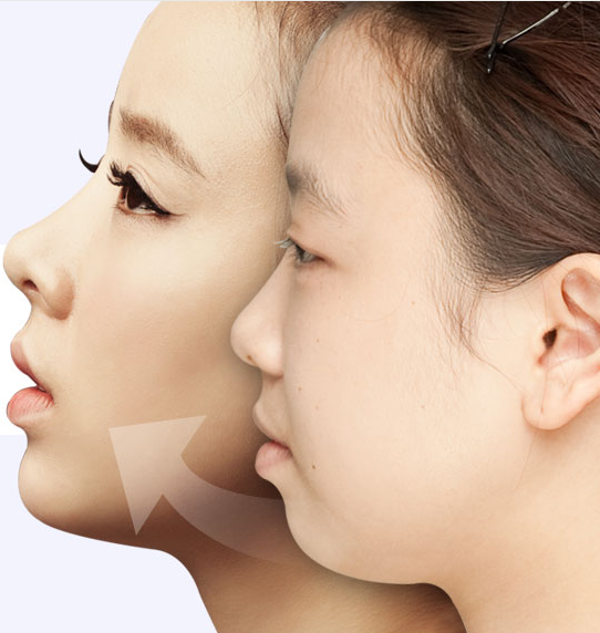 韩国topclass整形医院做立体脂肪填充