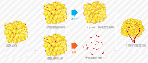 干细胞+自体脂肪移植术过程
