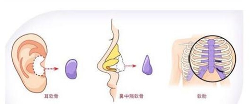 自体软骨类型