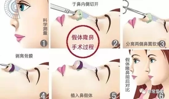 假体隆鼻手术卡通示意图