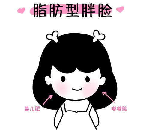 脂肪型胖脸