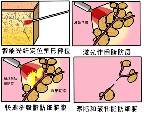 光纤溶脂过程