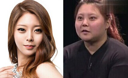 面部吸脂let美人案例