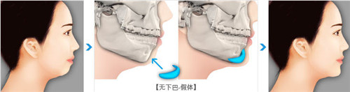 垫下巴效果前后对比