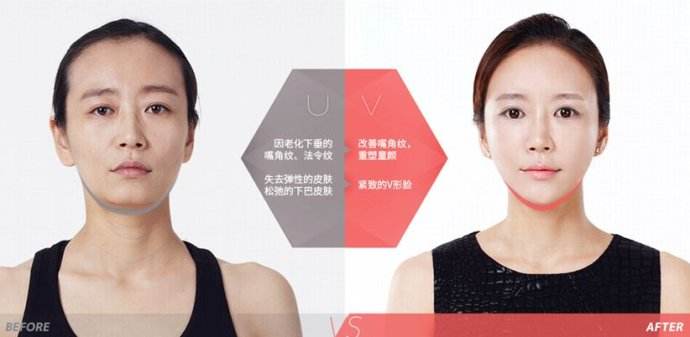埋线提升对比案例