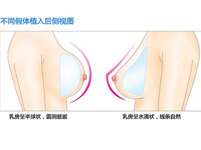 隆胸不同假体植入视图