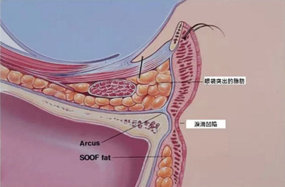 自体脂肪改善泪沟