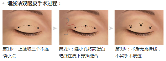 埋线法双眼皮手术过程