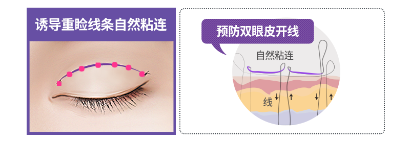 七点固定法双眼皮