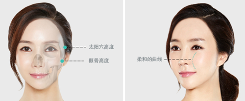 佳轮韩医院颧骨缩小手术优势