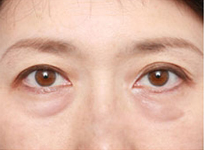 眼袋
