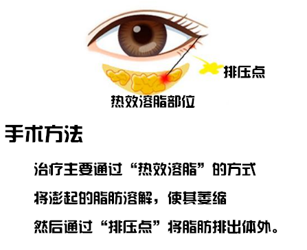 热效溶脂去眼袋手术方法