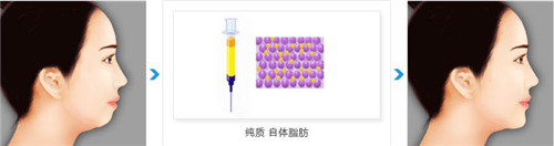 自体脂肪垫下巴