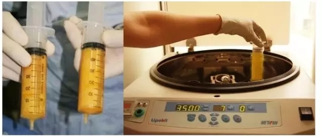 自体脂肪填充脂肪净化
