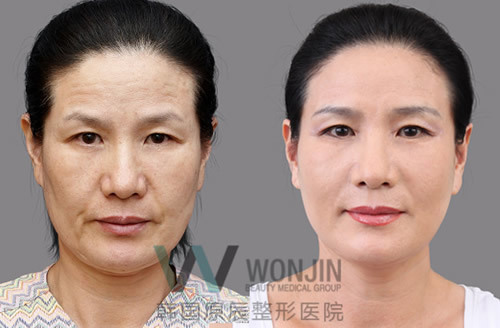 原辰整形外科埋线提升案例对比