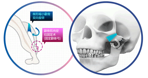 韩国TL整形外科颧骨缩小手术细节