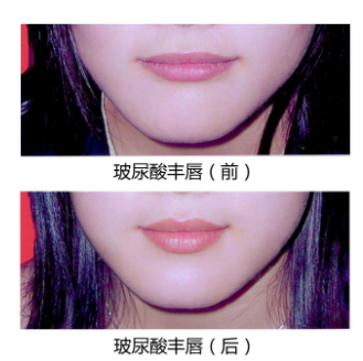 玻尿酸丰唇前后对比图