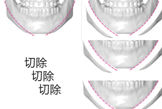 韩国gng下颌角手术示意图