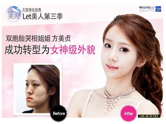 菲斯莱茵let美人轮廓手术对比.png
