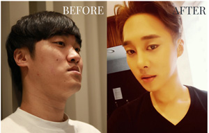 JSRO男性双鄂手术案例.jpg
