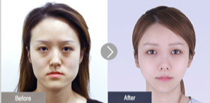 菲斯莱茵双鄂手术双胞胎姐妹方美晶.jpg
