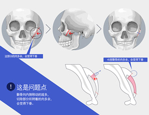颧骨手术后下垂的原因.jpg
