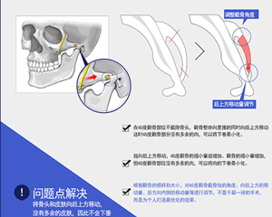 预防颧骨手术后下垂的方法.jpg
