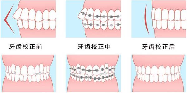 传统矫正器矫正过程