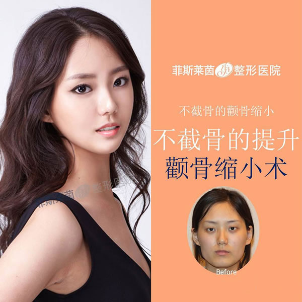 菲斯莱茵整形医院颧骨缩小术前后对比案例.jpg