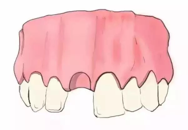 牙齿缺失