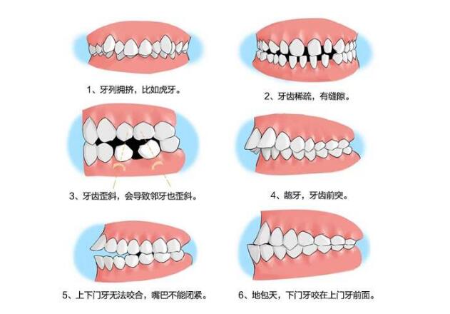 宁波牙齿矫正价格多少钱 牙齿矫正价格帮你具体分析