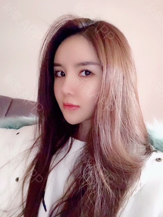 磨骨四件套术后第八天.jpg