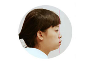 什么是突嘴？.jpg