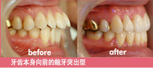 牙齿本身向前的龅牙突出型.jpg