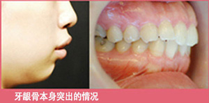 牙龈骨本身突出的情况.jpg