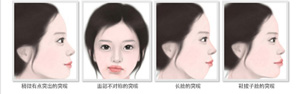 更适合做双颚手术的突嘴情况.jpg