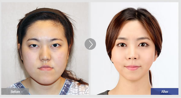 菲斯莱茵面部不对称案例前后对比图.jpg