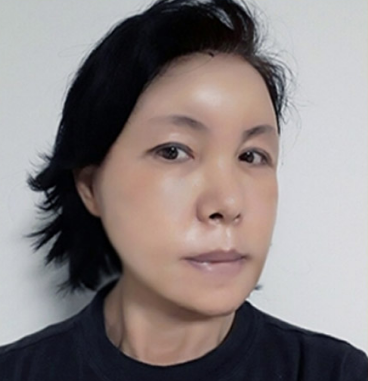 拉皮手术恢复中.png