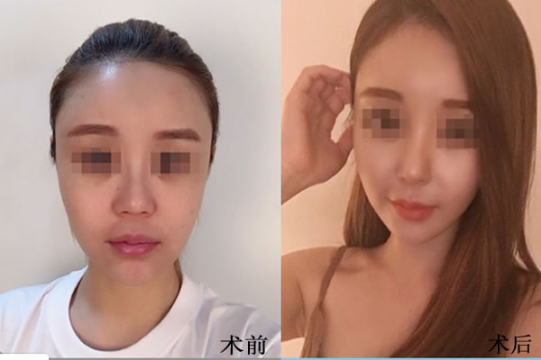韩国菲斯莱茵面部轮廓手术案例对比图.jpg