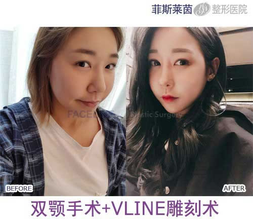 双颚手术+vline雕刻术多少钱.jpg