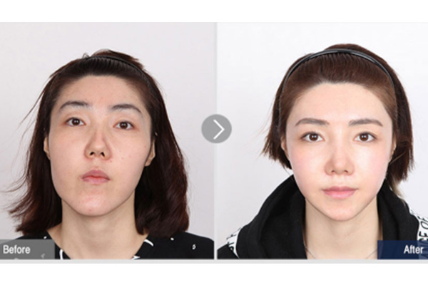 韩国菲斯莱茵手术案例对比图.jpg
